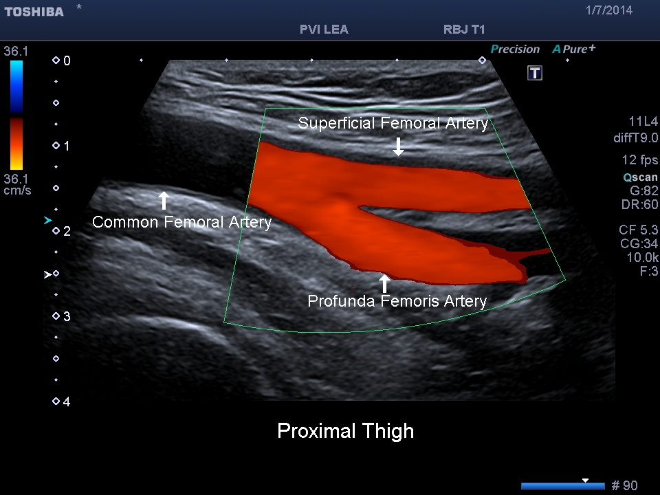 Peripheral Arterial Ultrasound Evaluations