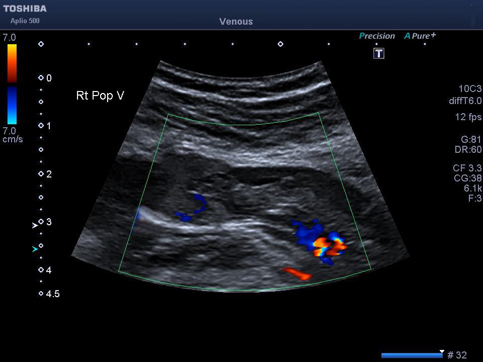 gastrocnemius vein ultrasound