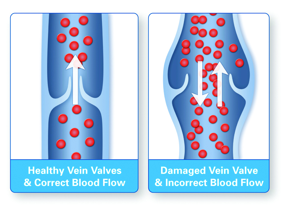 Peripheral Venous Evaluations